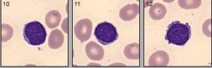 Normal appearing lymphocytes