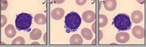 "Atypical" plasmacytoid appearing lymphocytes