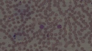 A hypersegmented neutrophil (left arrow) and macrocytic red blood cells (right arrow) (100x magnification)