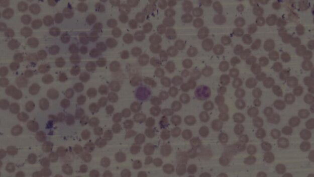 A hypersegmented neutrophil (left arrow) and macrocytic red blood cells (right arrow) (100x magnification)