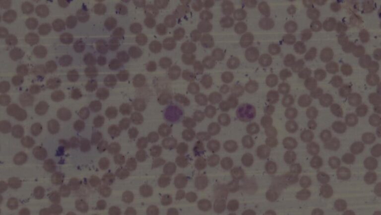 MDS1-Dysplastic cell A hypersegmented neutrophil (left arrow) and macrocytic red blood cells (right arrow) (100x magnification)