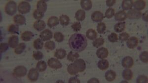 A dysplastic cell (left arrow) and rouleaux formation (right arrow) is evident (40x magnification)