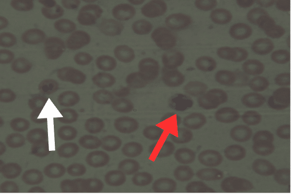 Malaria Case Study Image Figure 1. White arrow ring form and red arrow Schizont form
